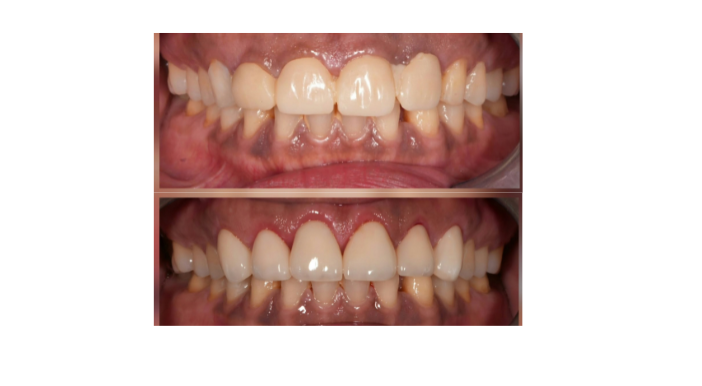 Before (top) and after (bottom) photos showing corrected teeth alignment: crowding reduced and an even bite with straight upper and lower teeth.