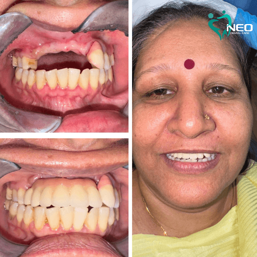 Dental before-and-after collage: upper and lower teeth before treatment on left, after restoration on bottom left; smiling patient on right with clinic logo.