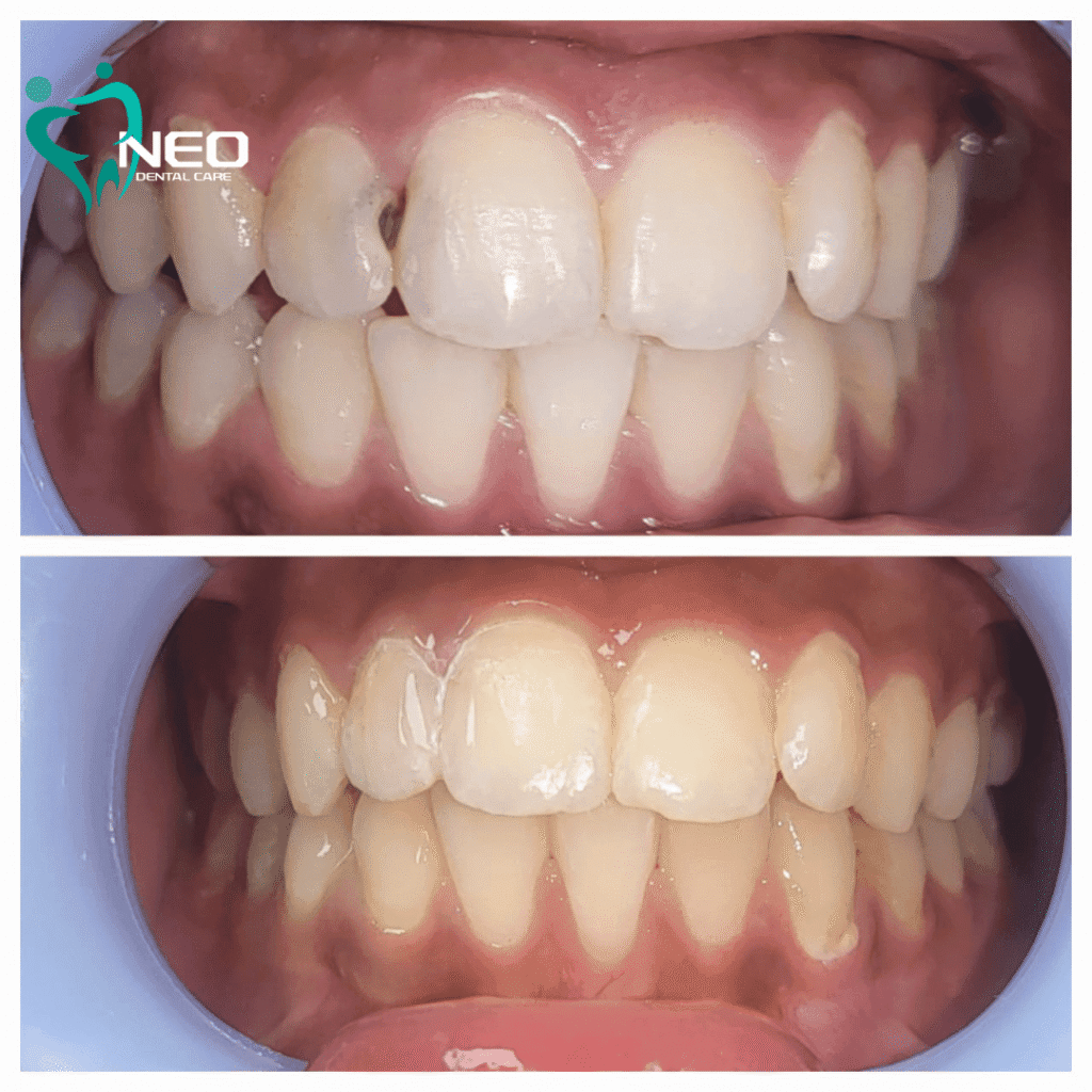 Two-panel dental after-and-before: top image shows crowded, misaligned upper teeth; bottom image shows straightened teeth after orthodontic treatment, with Neo Dental Care logo.