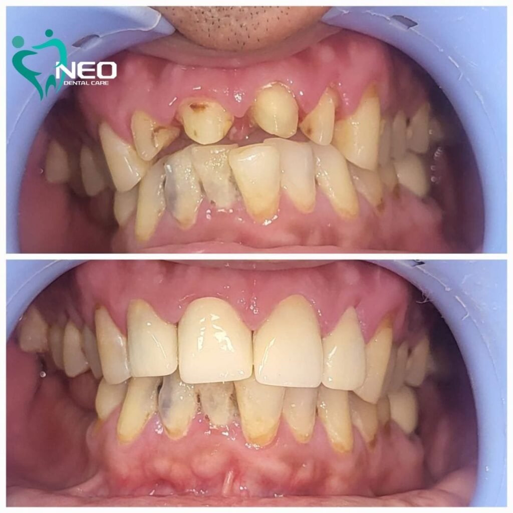 Before-and-after dental treatment: top image shows severely worn, chipped teeth; bottom image shows straight, whitened teeth after crowns/cosmetic restorations.