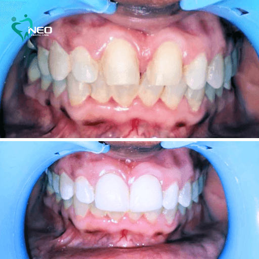 Two-panel image: top shows crowded, misaligned teeth; bottom shows straight, evenly spaced teeth after orthodontic treatment (before/after comparison).