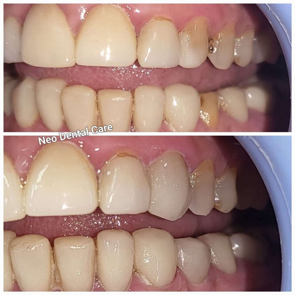 Before-and-after dental photos showing improved alignment: upper teeth straighter, lower teeth less crowded after treatment at Neo Dental Care.