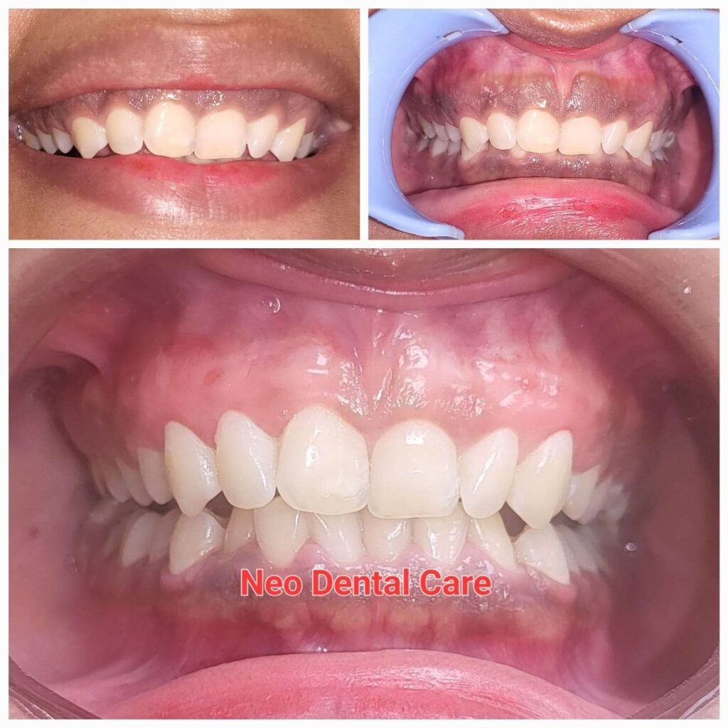 Collage of dental treatment results: improved alignment of upper and lower teeth with healthy gums; before-and-after views including a bite screenshot; Neo Dental Care watermark present.