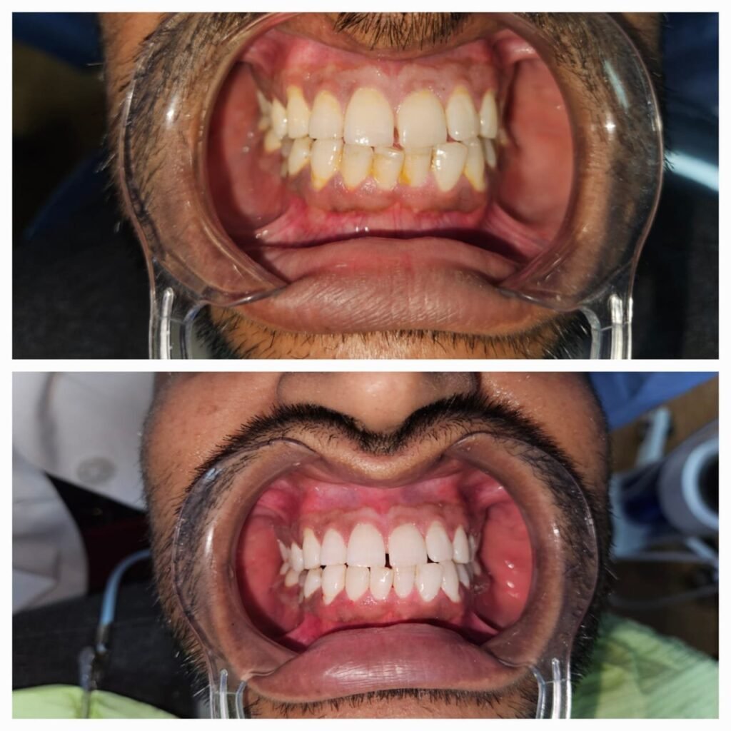 Before (top) and after (bottom) dental treatment: crowded yellow teeth with inflamed gums transform to straight, white teeth with healthier gums.