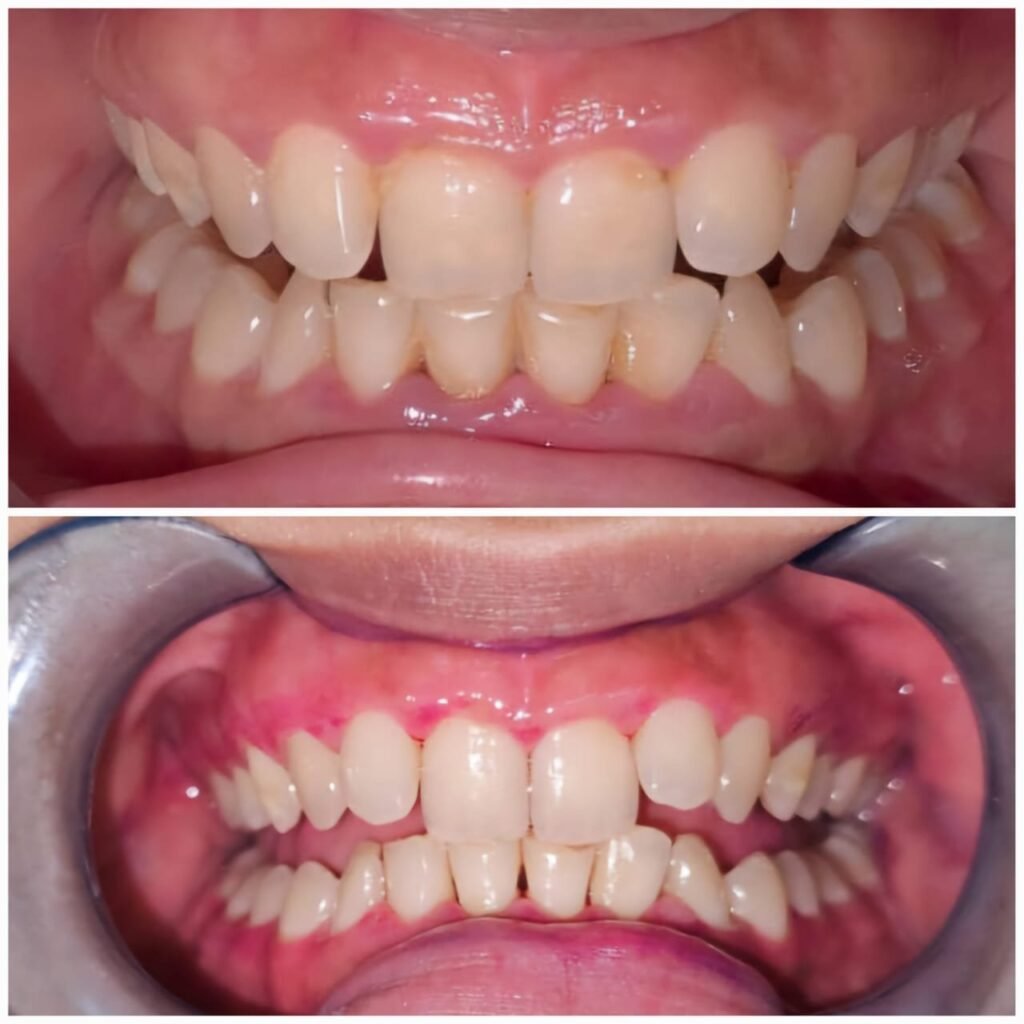 Two-panel photo: top image shows crowded, misaligned teeth; bottom image shows improved alignment after treatment with teeth more evenly arranged.