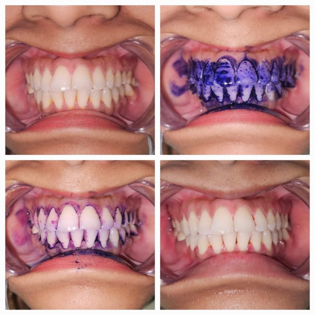 Four-panel collage showing a patient's teeth during a whitening treatment: top-left enamel appears natural and unaltered; top-right teeth with whitening gel applied inside a cheek retractor; bottom-left close-up with gel smeared on teeth and gums; bottom-right final result with noticeably whiter teeth and closed-lip smile.