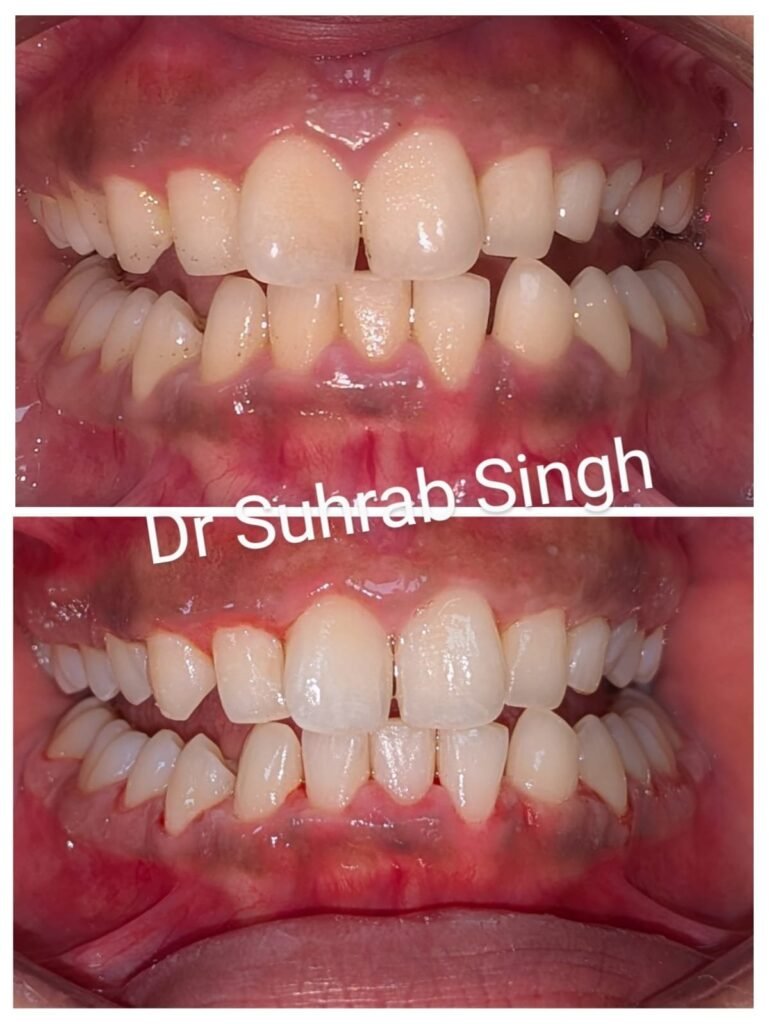 Before-and-after close-up of a smile showing crowded, misaligned front teeth and inflamed gums, with improved alignment in the after image (watermark: Dr Suhrab Singh).