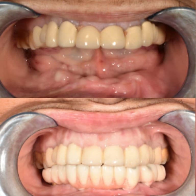 Top image shows an upper denture in place over the gums. Bottom image shows a full set of upper and lower dentures in a closed bite.