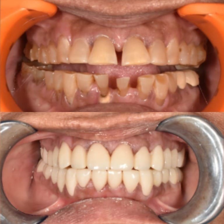 Before-and-after dental restoration: top image shows severely worn, misaligned upper teeth; bottom image shows a full set of straight, evenly spaced, white teeth after treatment.