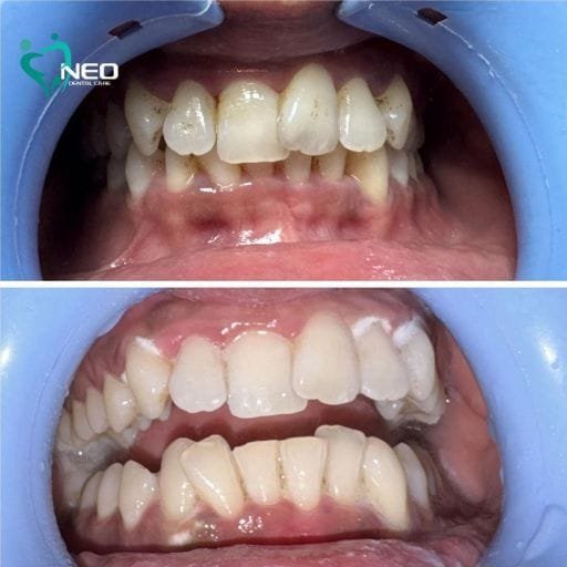 Two-panel close-up of a patient’s teeth before (top) and after (bottom) orthodontic treatment, showing improved alignment and bite symmetry, with a dental clinic logo in the corner