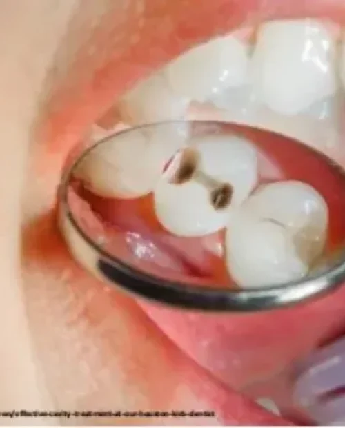 Tooth Cavity Treatment